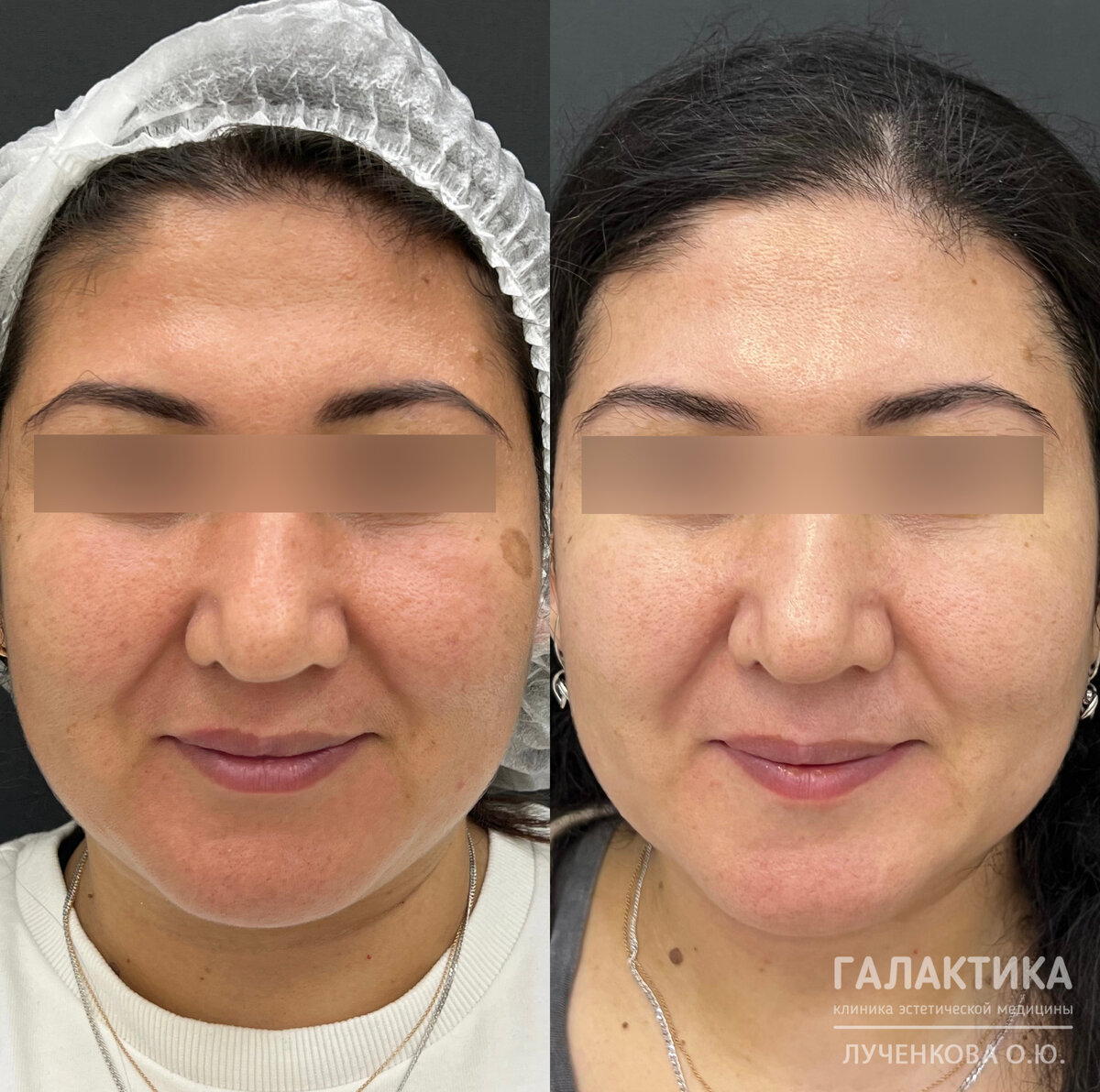 Результат фототерапии