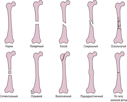 Видов переломов больше, чем я описал. На этой картинке есть еще. Фото взято с источника: https://goo.su/ztrM