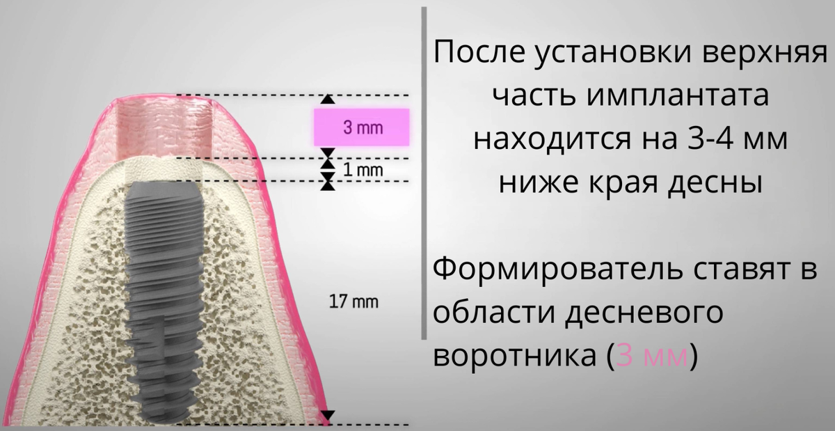 Фото после установки формирователя десны Формирователь десны СТАНДАРТНЫЙ медицинские, зубной, стоматологические, материал