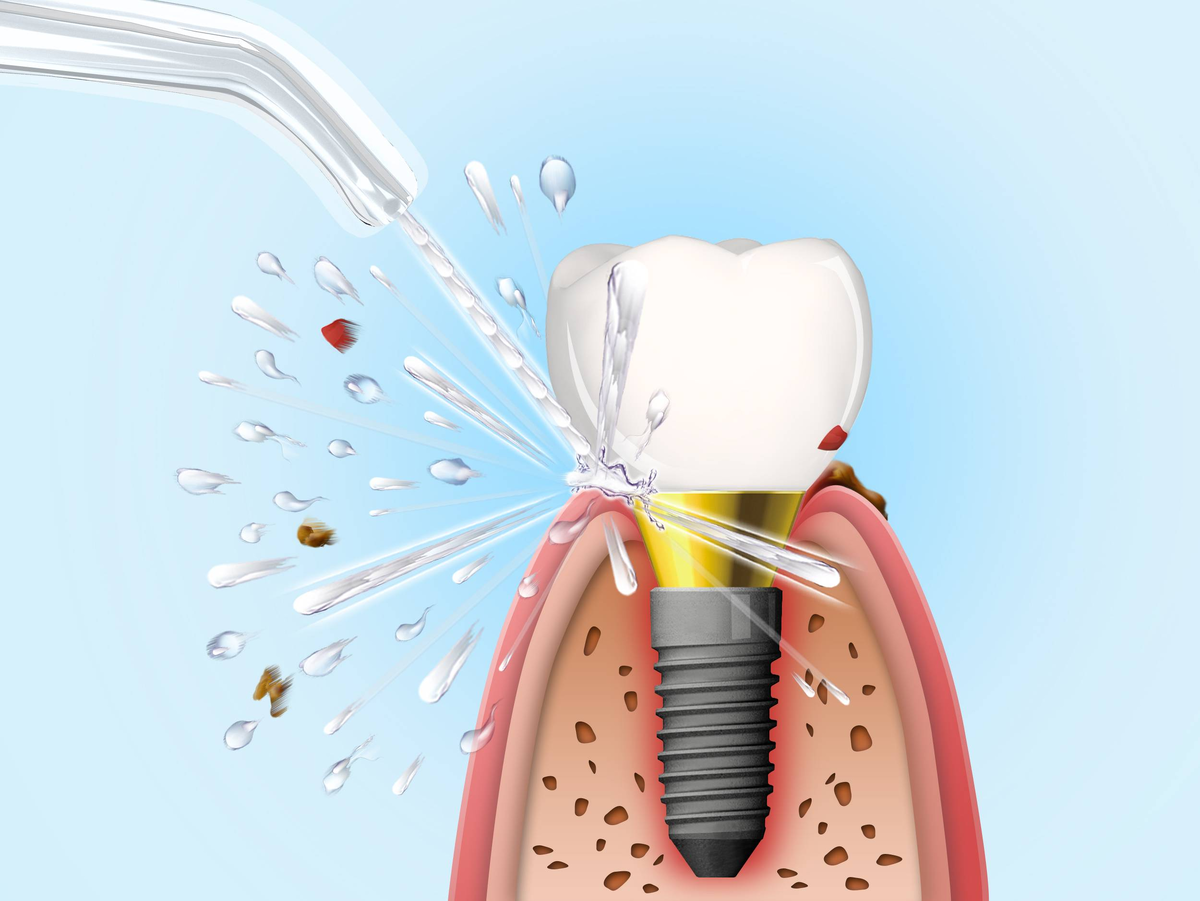 Чем промывают зубы. Ирригатор для имплантов. Гигиена полости рта с имплантами. Ирригатор для имплантов и коронок.
