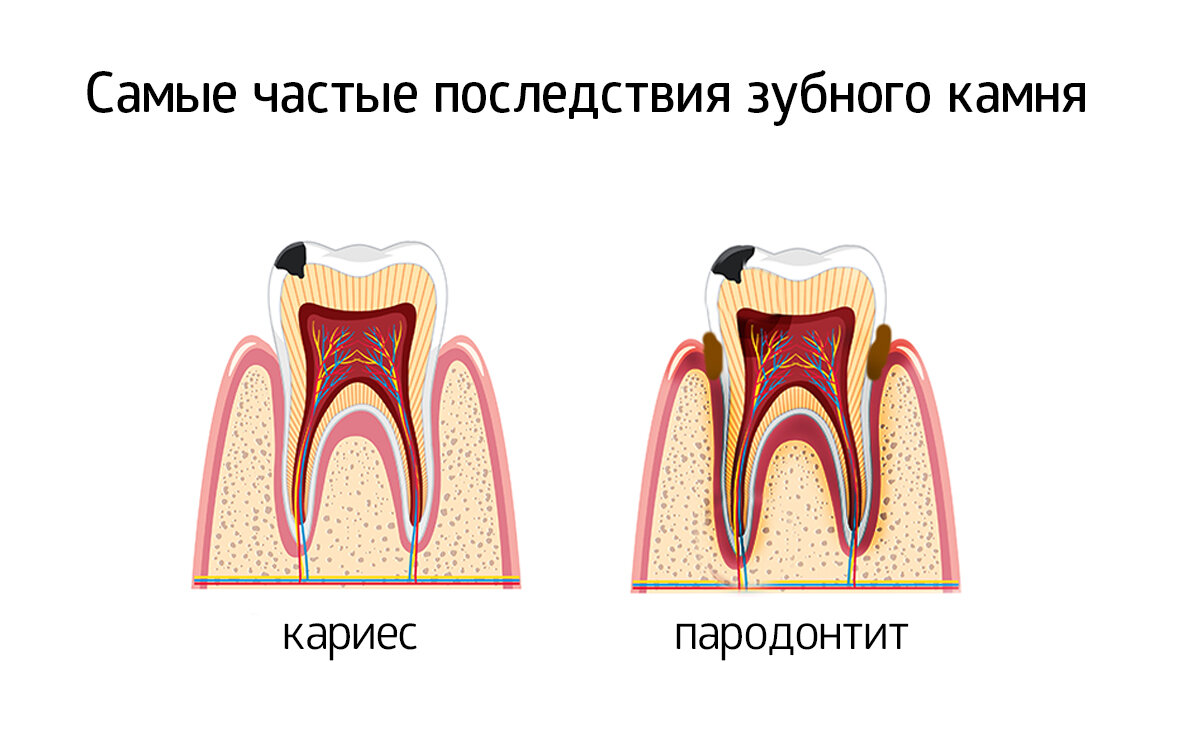 Как зубная щётка спасает от инфарктов и инсультов - АУ "Новочебоксарская городск