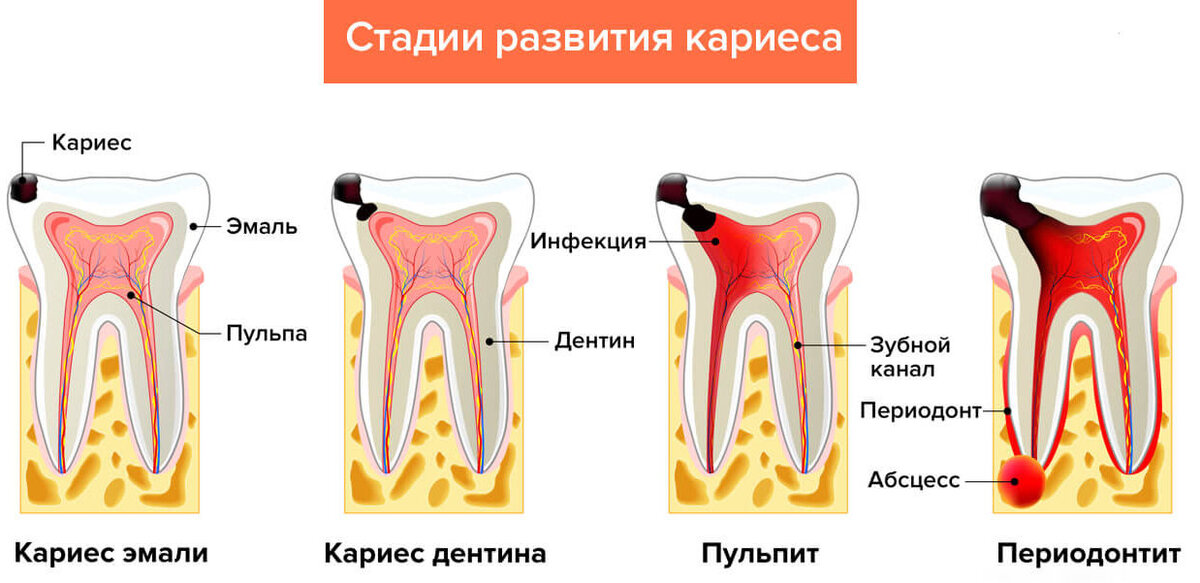 Воспаление зуба лечение. Кариес эмали дентина и цемента. Этапы пульпита периодонтит.