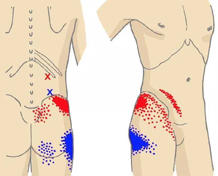 Болят бедра у мужчины. Триггерные точки бедра. Триггерные точки поясничного отдела. Триггерные точки бедра и спина. Боль в пояснице триггерные точки.
