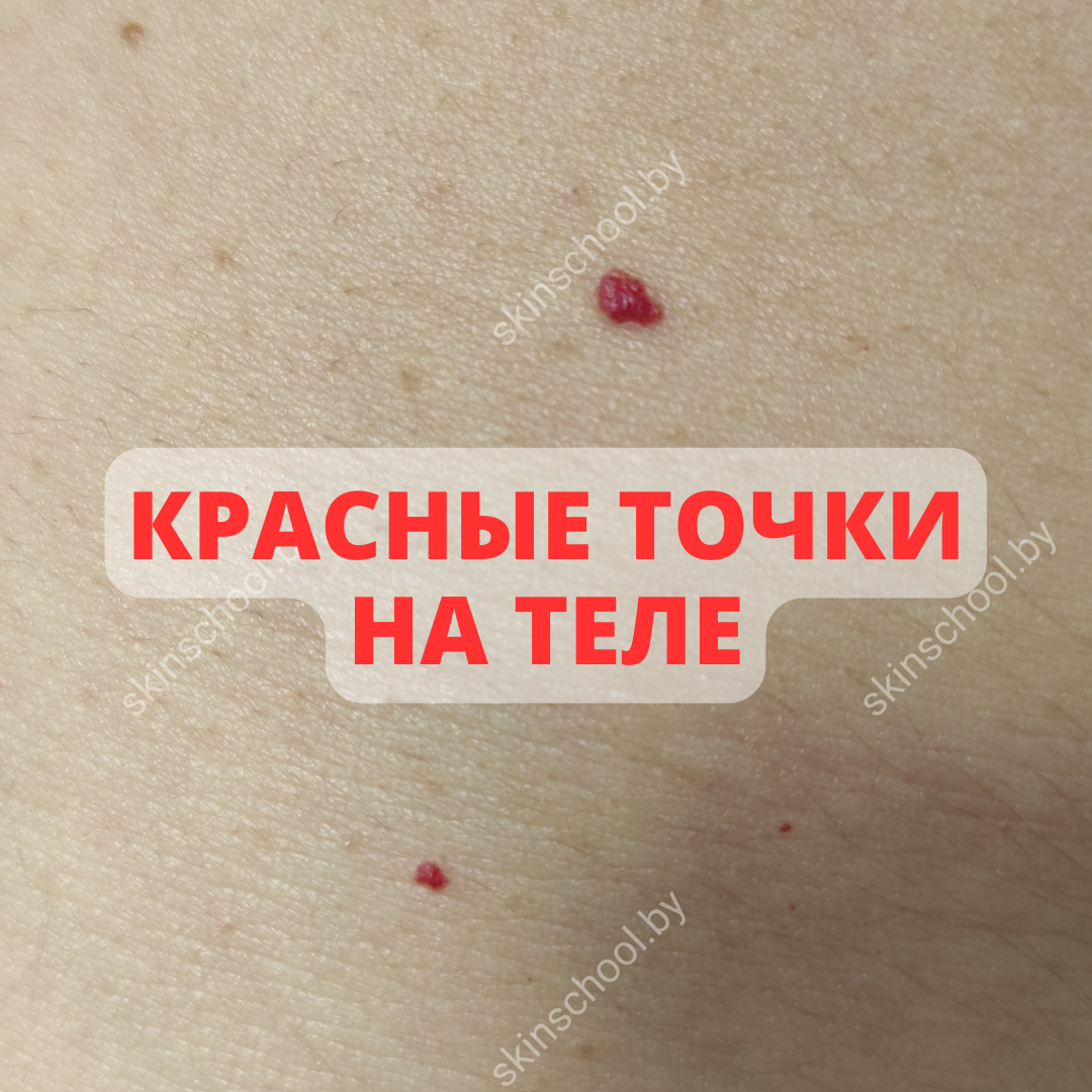 Красные точки на теле | Советы дерматолога|Sovetydermatologa | Дзен