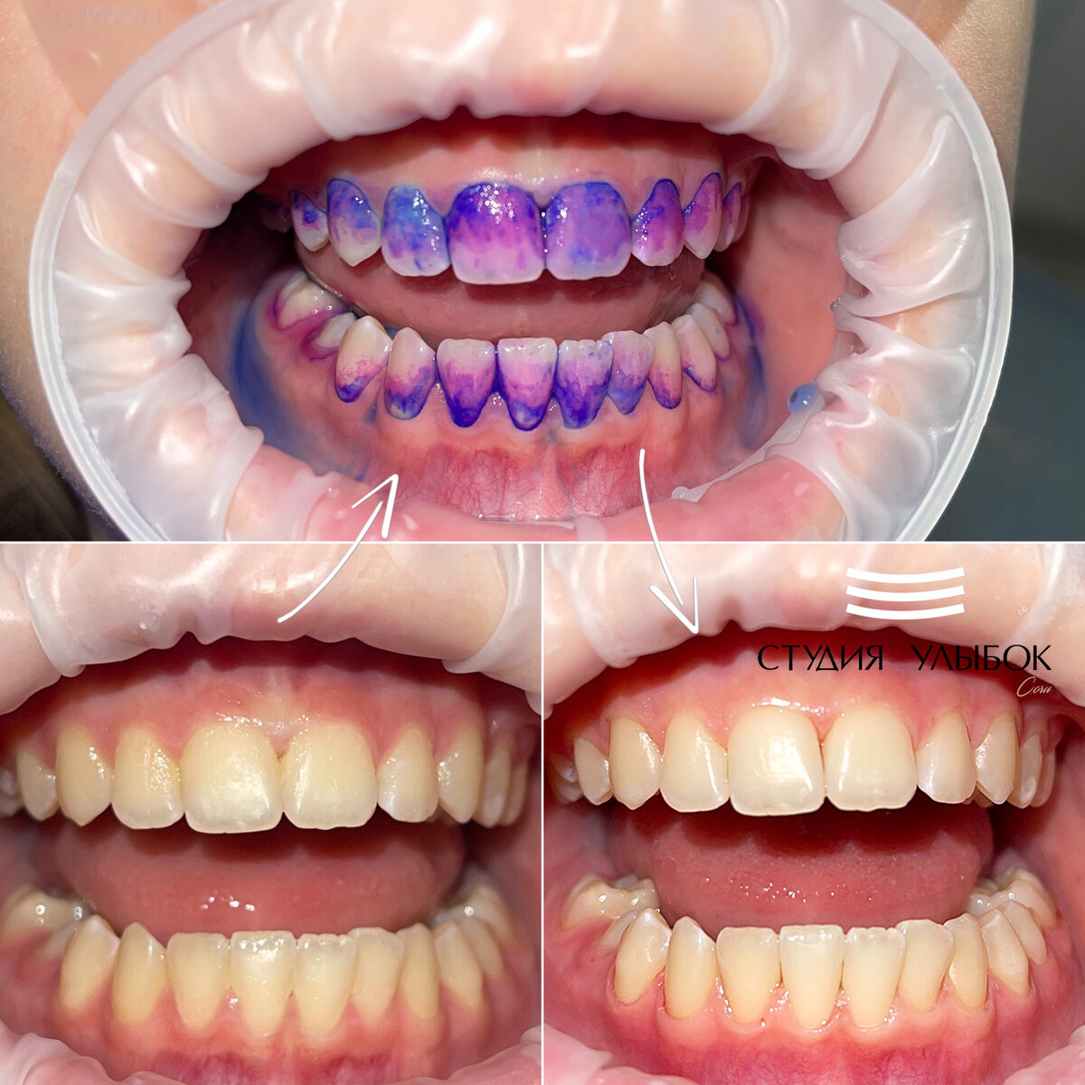 Индикатор налета на зубах