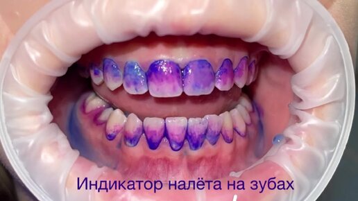 Стоматология СТУДИЯ УЛЫБОК г. Сочи | Так индикатор налета показывает ...