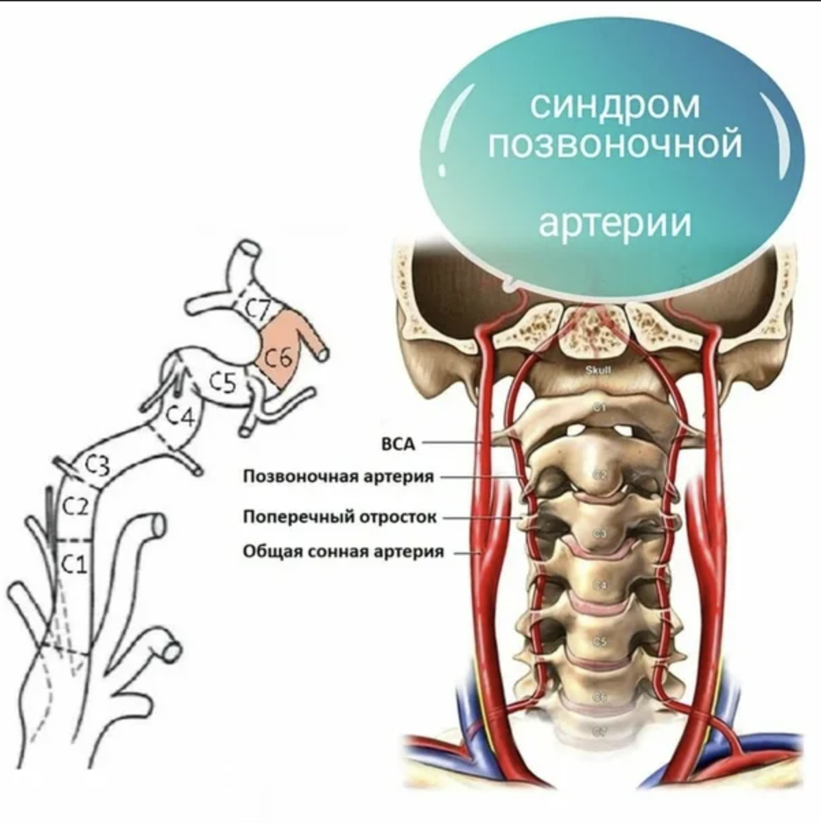 Шейный синдром позвоночной артерии. Вертебральный синдром позвоночной артерии. Сегмент v1 v2 позвоночной артерии. Интракраниальные сегменты позвоночных артерий.