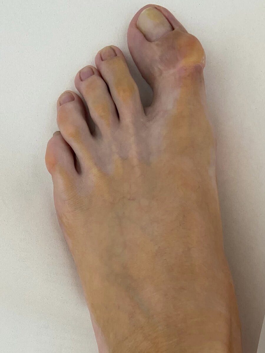 Эту стопу до меня уже оперировали