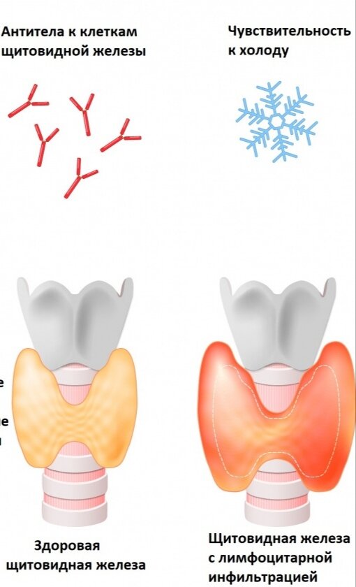 Аутоиммунный тиреоидит - причины, симптомы, признаки, диагностика, лечение, диета
