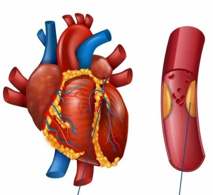 Атеросклеротические бляшки в кровеносных сосудах сердца 