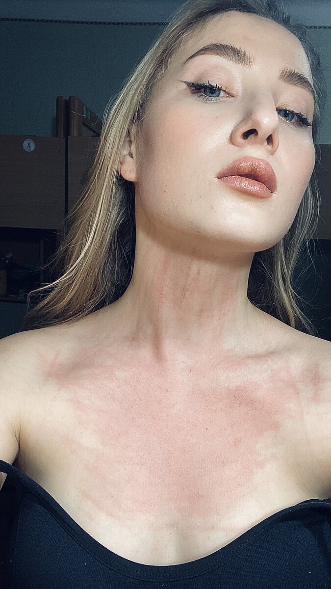 Это я на фоне тревоги очень хотела расцарапать себе шею. 