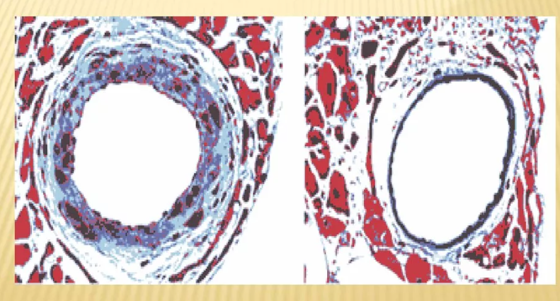 При артериальной гипертонии, как и при атеросклерозе,  первые мишени этих болезней - артерии. Всё остальное страдает постольку, поскольку страдают артерии