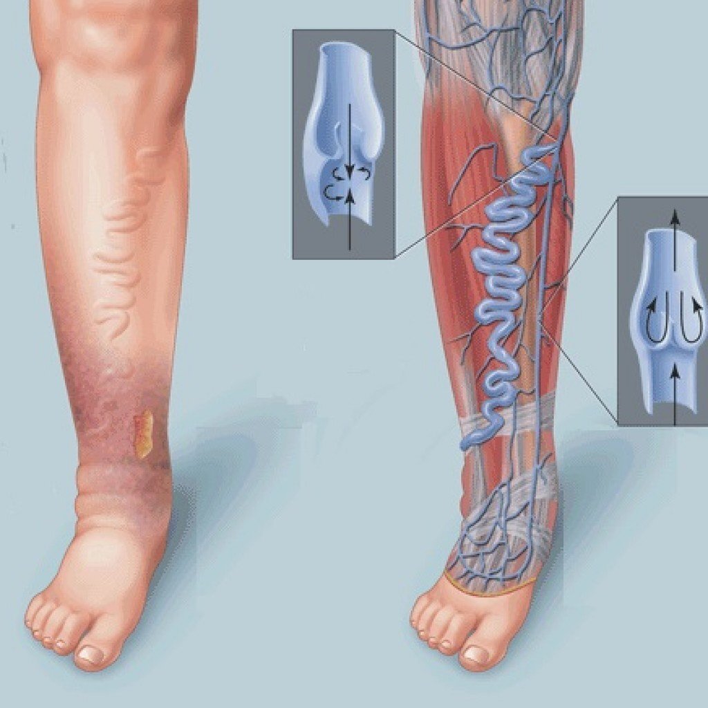 Варикозное расширение вен нижних конечностей ХВН