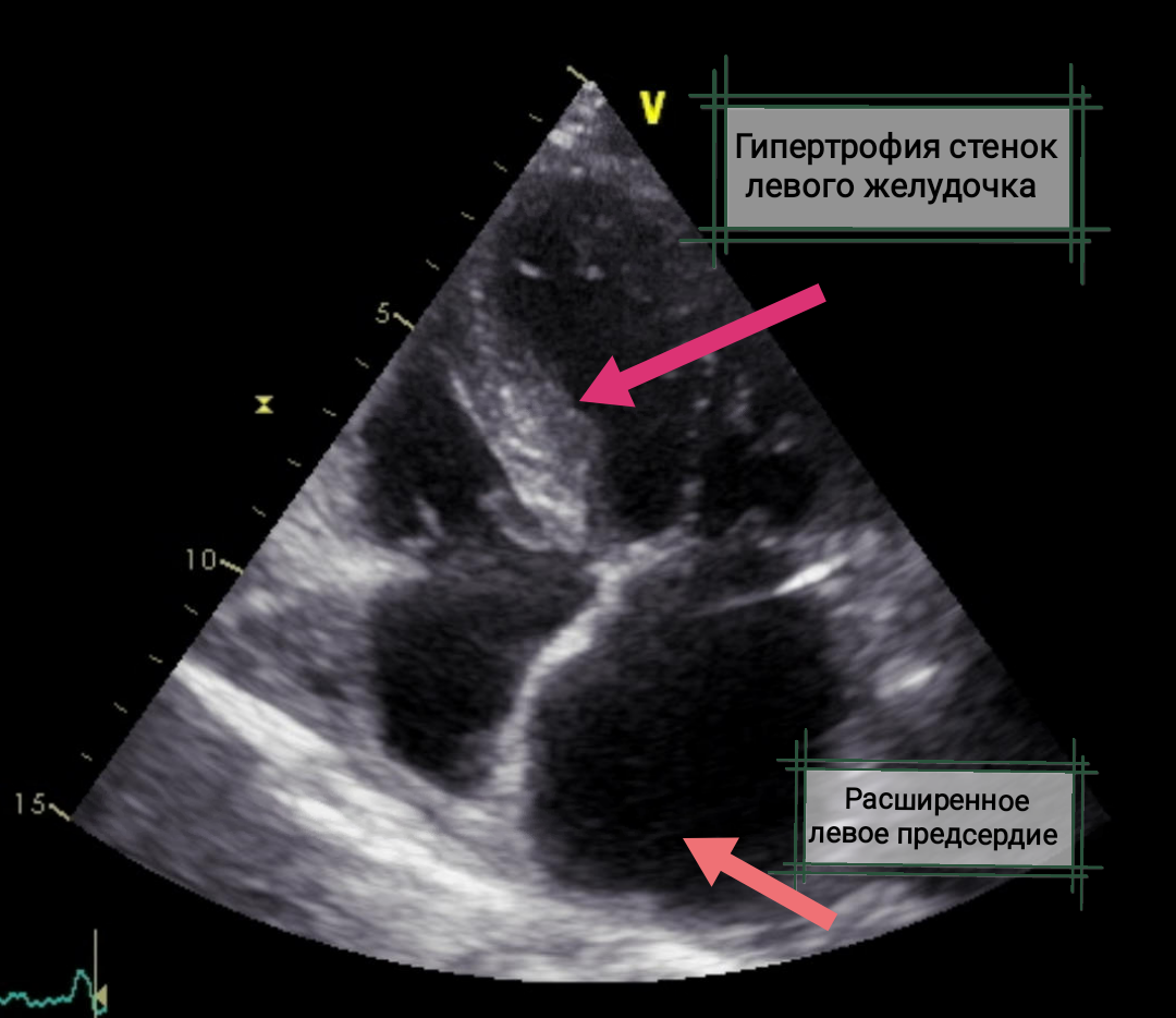 На УЗИ сердца видны последствия нелеченной/плохо контролируемой артериальной гипертензии - утолщение стенок левого желудочка и расширение левого предсердия 