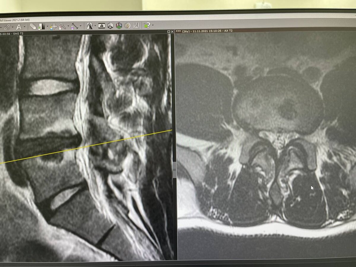 Грыжа Шморля