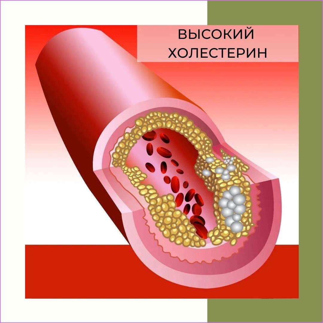 ВЫСОКИЙ ХОЛЕСТЕРИН