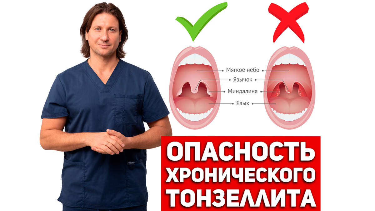 Хронический тонзиллит убивает ваш организм! | Клиника Доктора Длина | Дзен