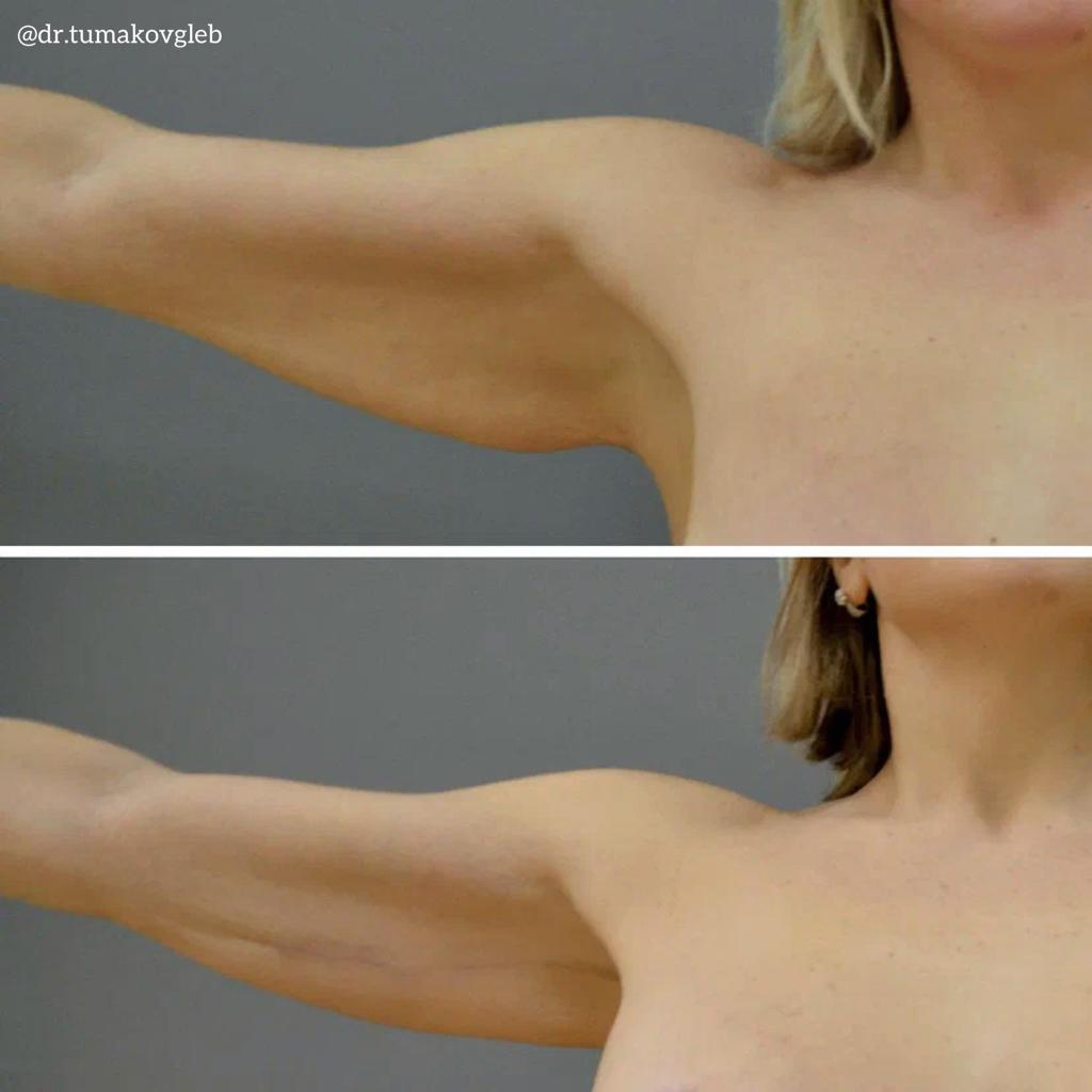 Результат брахиопластики.