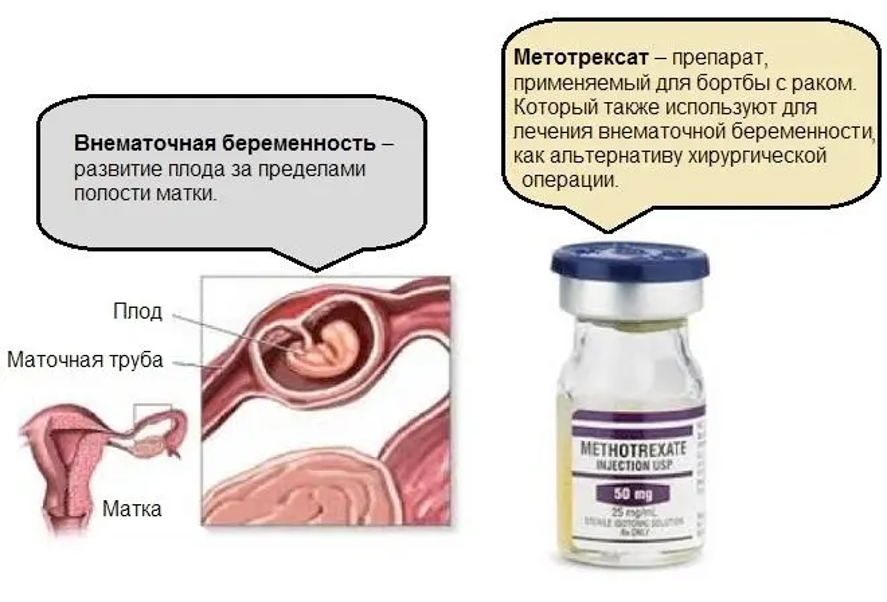 Метотрексат при внематочной беременности. Таблетки от внематочной беременности. Диагностика внематочной беременности. Лекарство от внематочной беременности на раннем сроке. Беременность после внематочной.