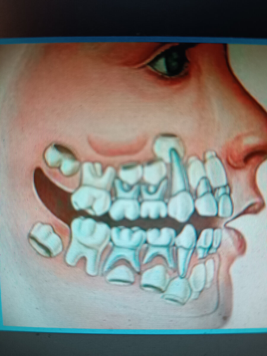 Так выглядят зачатки постоянных зубов. Их корни еще не сформированны.