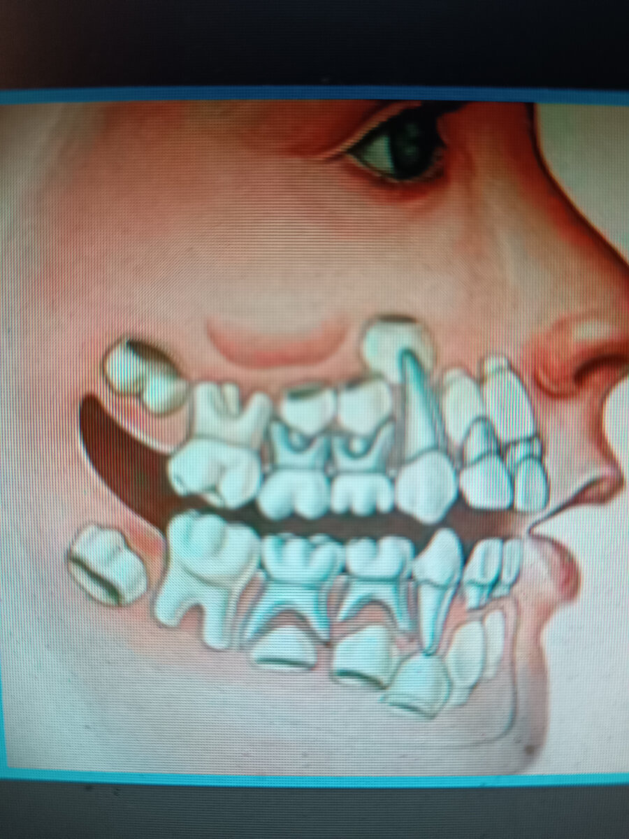 Молочные зубы. Они же все равно выпадут. Зачем их лечить? | Стоматолог и  его Я | Дзен