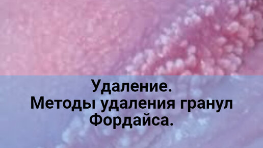 Удаление. Методы удаления гранул Фордайса на головке полового члена.