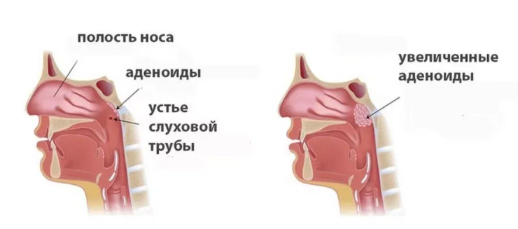 Где аденоиды у ребенка