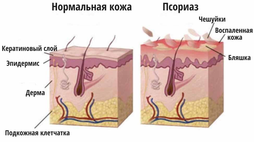 помогите! псориаз! - 32 ответа - Здоровье, Красота, Диеты - Форум Дети спогрт.рф