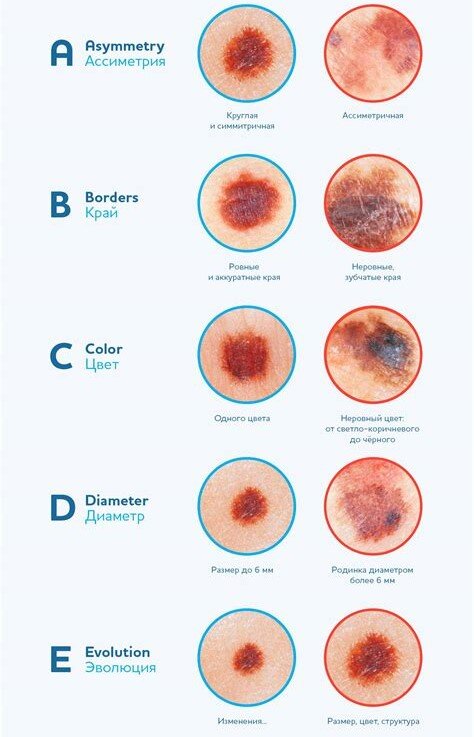 Как узнать симптомы фото Критерии ABCDE как оценка риска развития меланомы Медицинские записки Дзен