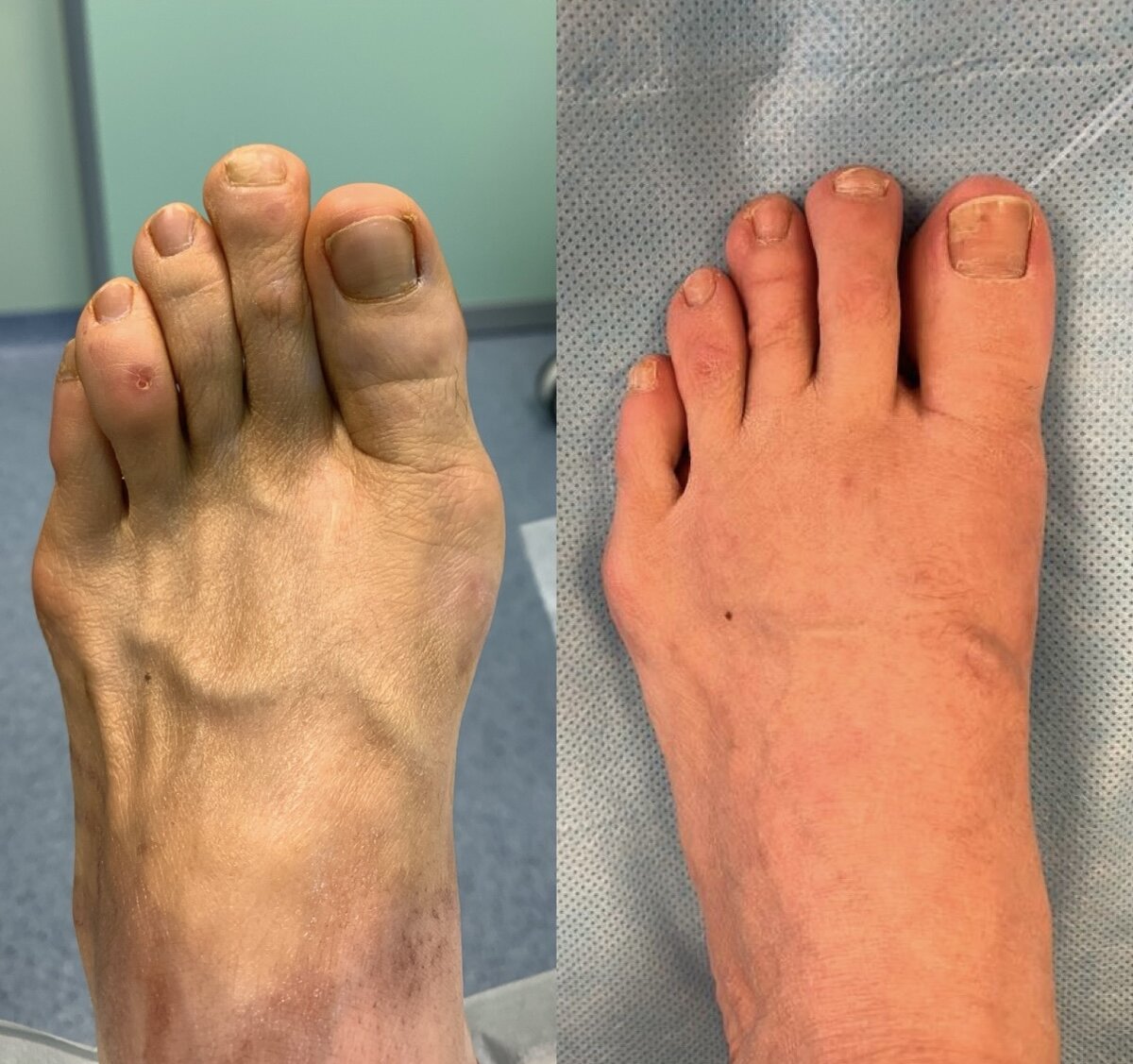 ОПЕРАЦИЯ ПРИ КОСТОЧКАХ, ШИШКАХ, HALLUX VALGUS - что нужно знать и понимать  перед принятием решения | О СУСТАВАХ ПРОСТО И ЧЕСТНО - ортопед Андрей  Карданов | Дзен