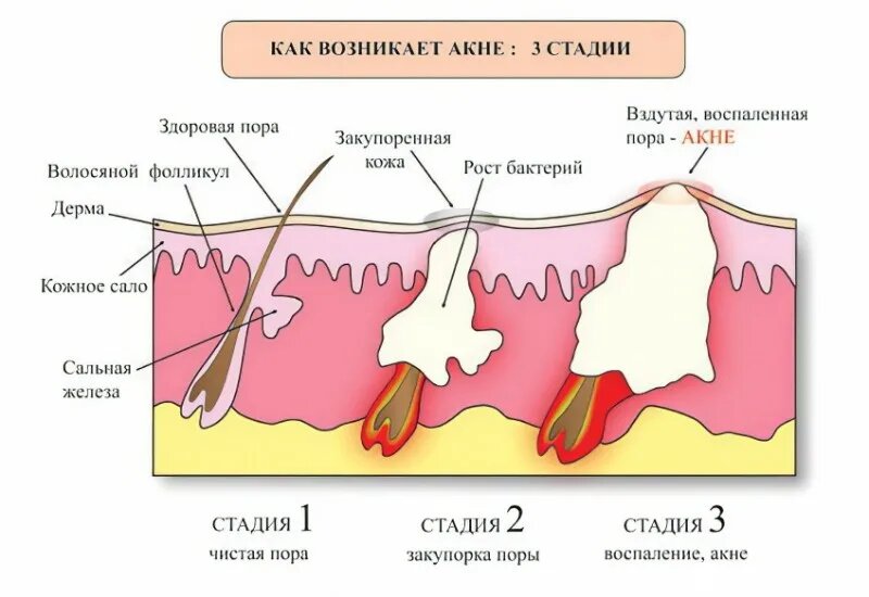 Прыщ в разрезе картинка