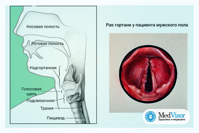 Лечение рака гортани (рак горла) в Германии