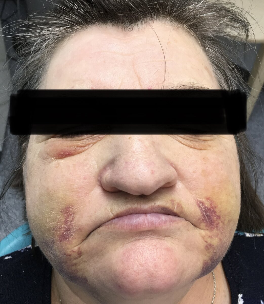 Отёк после открытого синуслифтинга