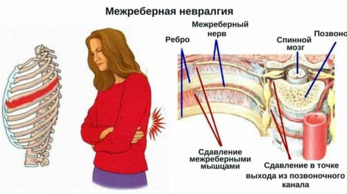 Межреберная невралгия у женщин и мужчин: причины, симптомы и лечение