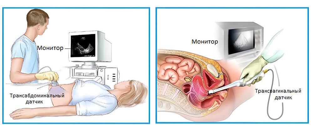 Виды УЗИ малого таза
