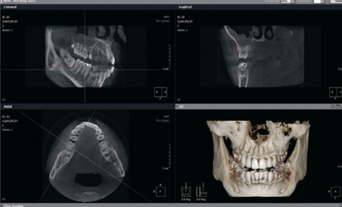 Снимки верхней и нижней челюсти. Компьютерная томография нижней челюсти на остеомиелит. Кт 3d верхней и нижней челюсти. Кт 3д зубочелюстной системы.