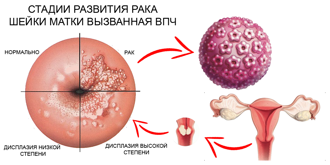 Рак шейки матки занимает второе место по заболеваемости среди женщин от 30 до 59 лет в России. 