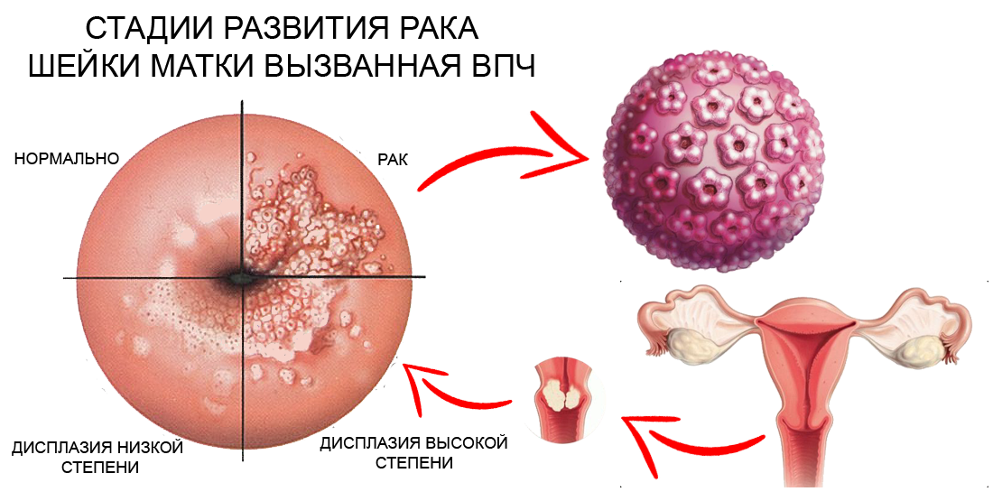 Впч шейки. Кондиломы урогенитальные. Генитальные бородавки ВПЧ.