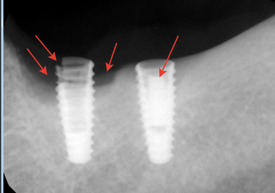 перелом стенки имплантата слева, убыль костной ткани вокруг имплантатов, в имплантате справа внутри сломанный винт 🤷‍♂️