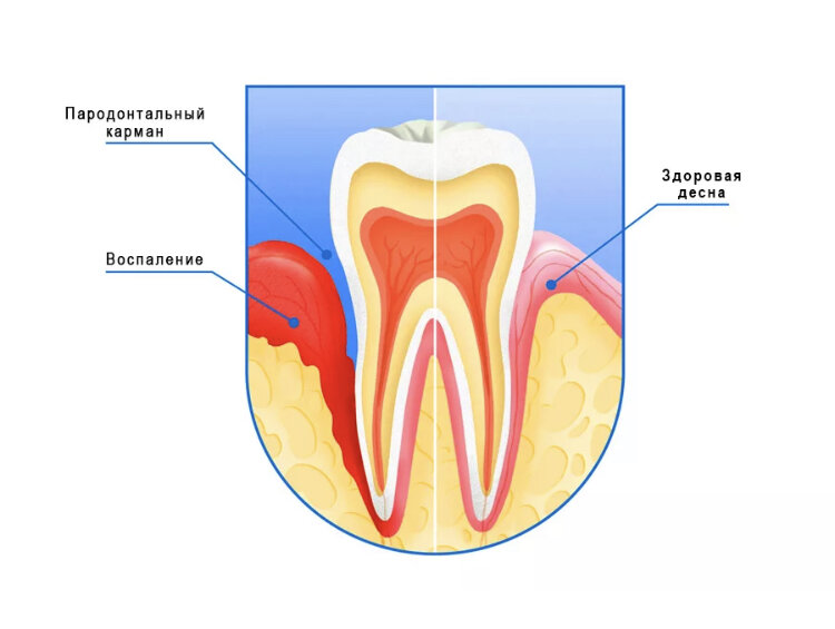 Воспаление зуба лечение. Воспаление зуба симптомы.