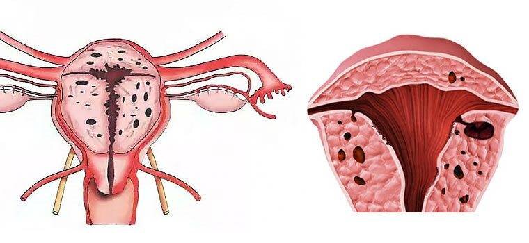 Что такое картина аденомиоза