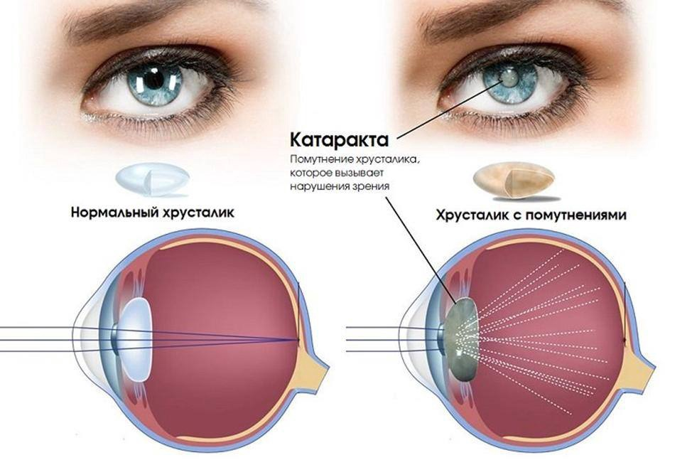 Что можно делать после катаракты. Катаракта – помутнение хрусталика глаза.. Катаракта схема глаза. Катаракта хрусталик строение. Катаракта глаза катаракта схема.