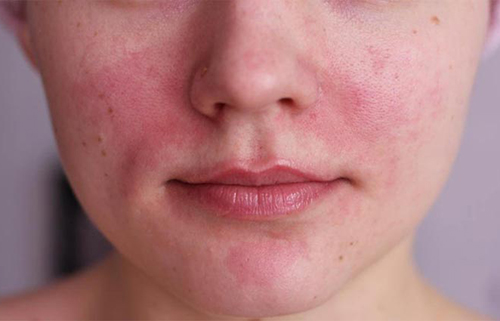 Как проявляется аллергия?