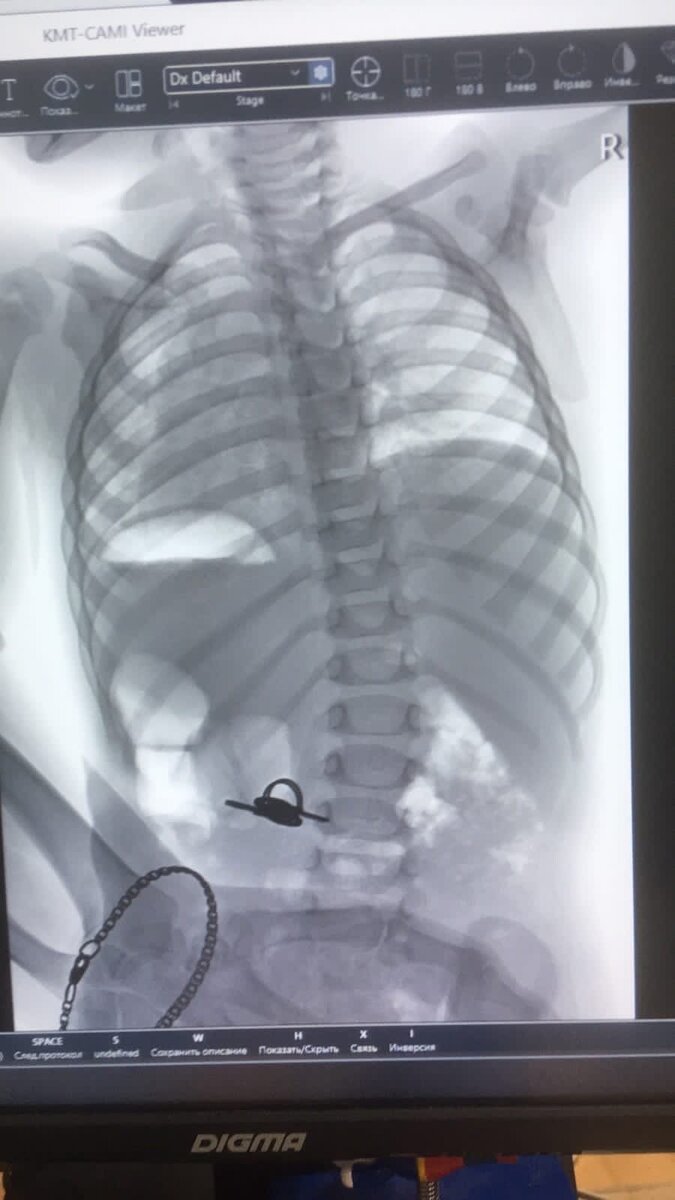 На снимке видны ключи в желудке, а также браслет на маминой руке (девушка придерживала ребенка во время снимка)