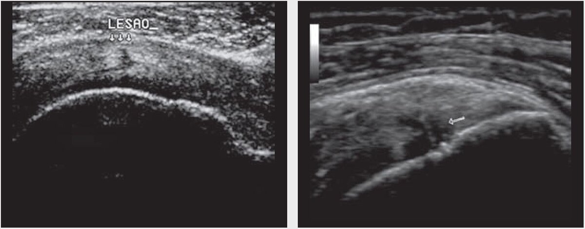 Рис. 1. Наиболее распространенные ультрасонографические аспекты частичных повреждений вращательной манжеты. (a) Безэховое повреждение (стрелки), расслаивающее сухожилие. (b) Перелом смешанного типа, с эхо-насыщенными и эхо-неплотными участками внутри (стрелка).