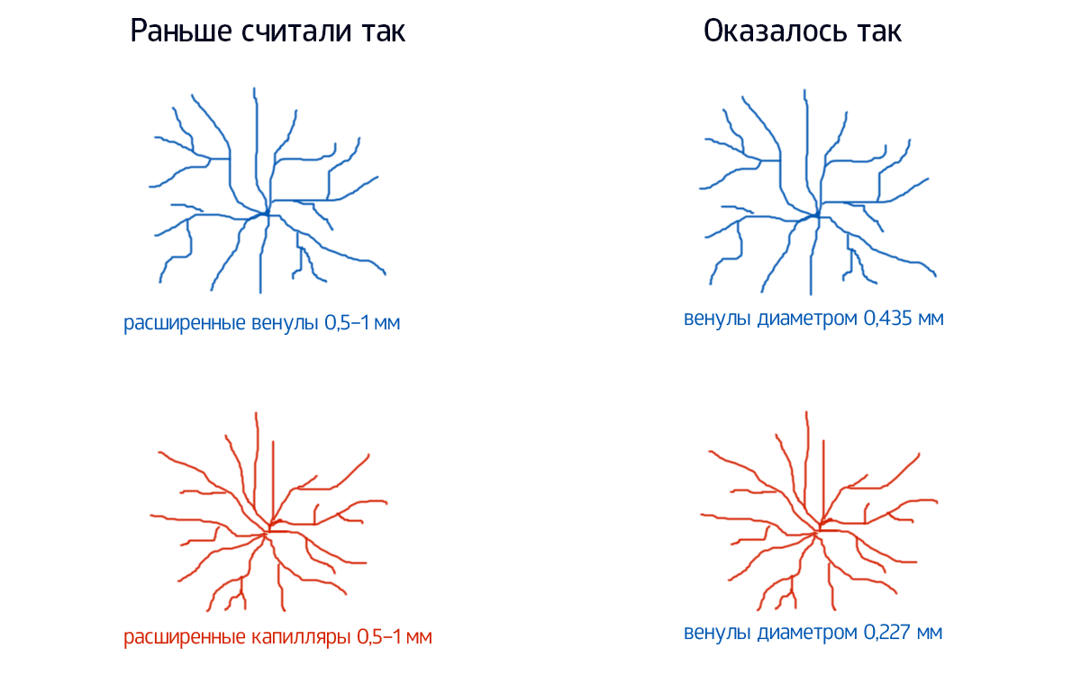 Сосудистый рисунок у ребенка