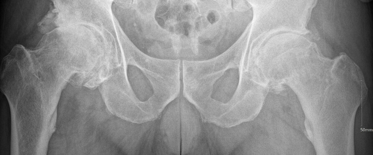 Рентген снимок двустороннего коксартроза. Слева для вас - правый сустав, он хуже.