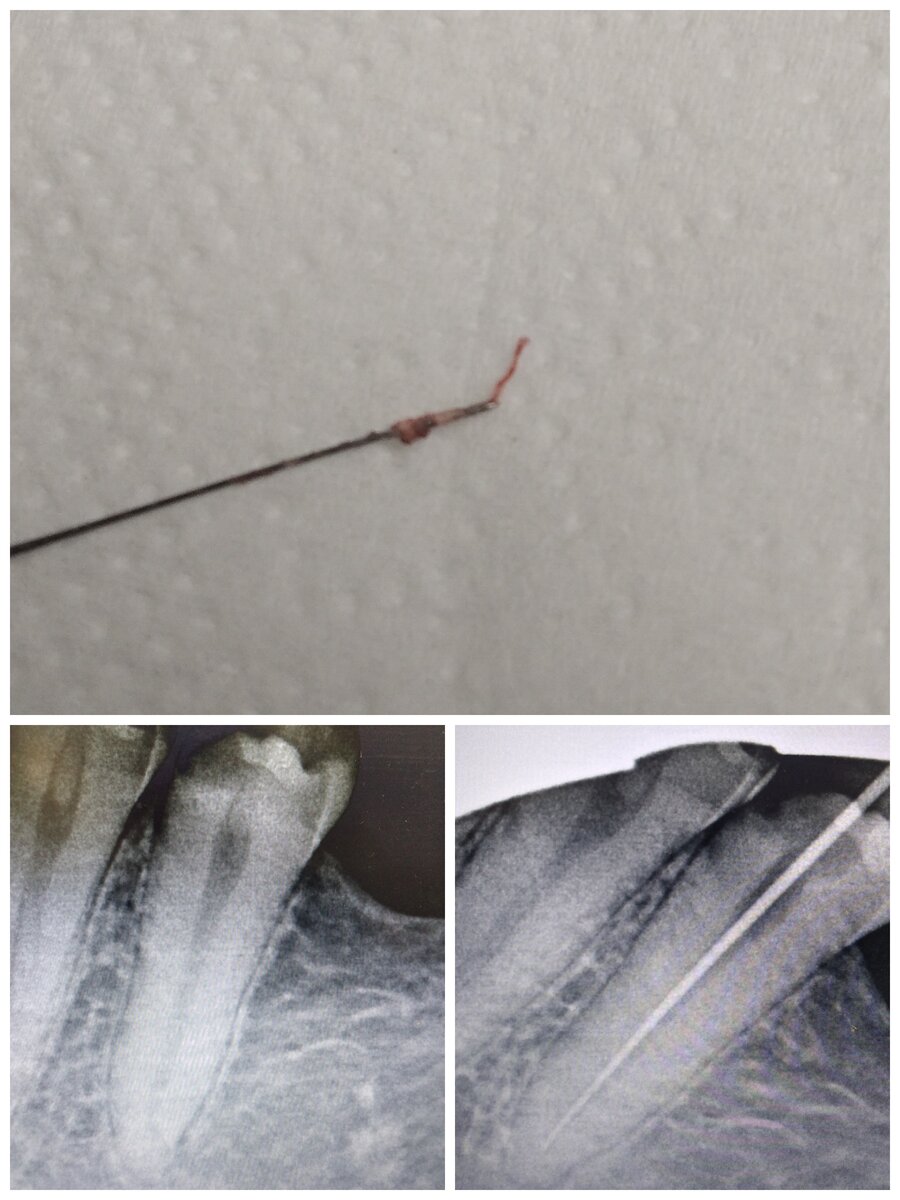 During my root canal the doctor accidentally pulled out the entire nerve in one 