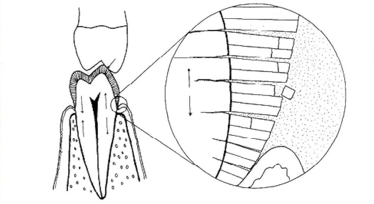 Выбивание эмали из пришеечной области из -за чрезмерной нагрузки.