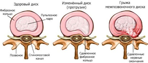 Строение межпозвоночного диска в норме и патологии.  